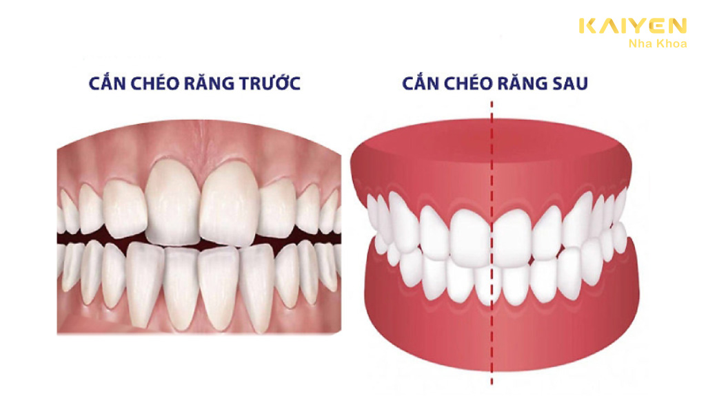 Các loại khớp cắn chéo