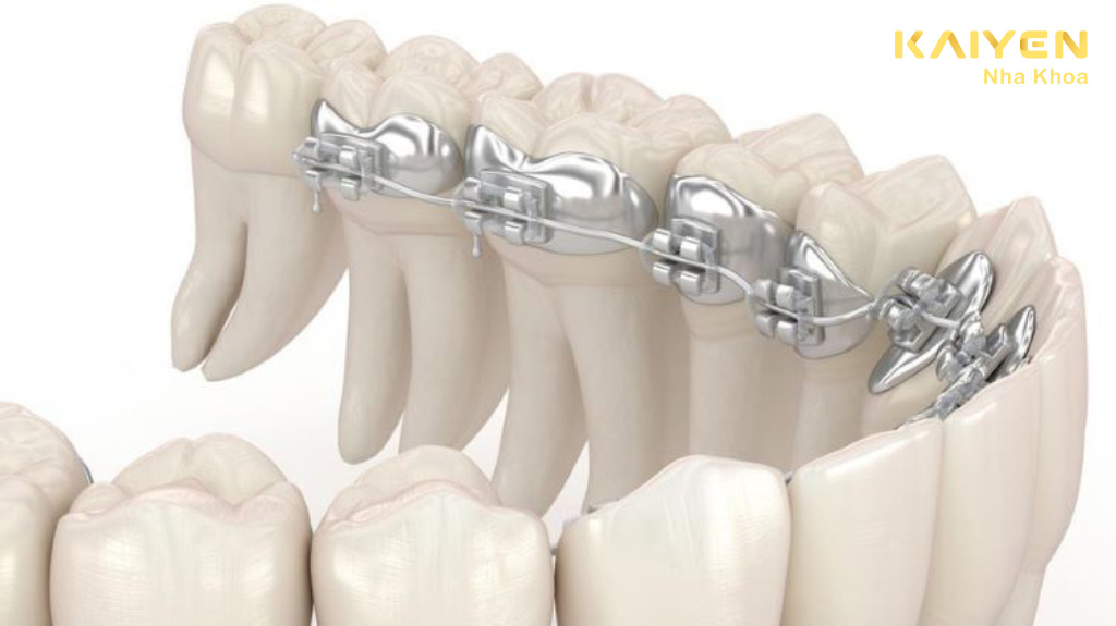 kỹ thuật niềng răng mặt trong