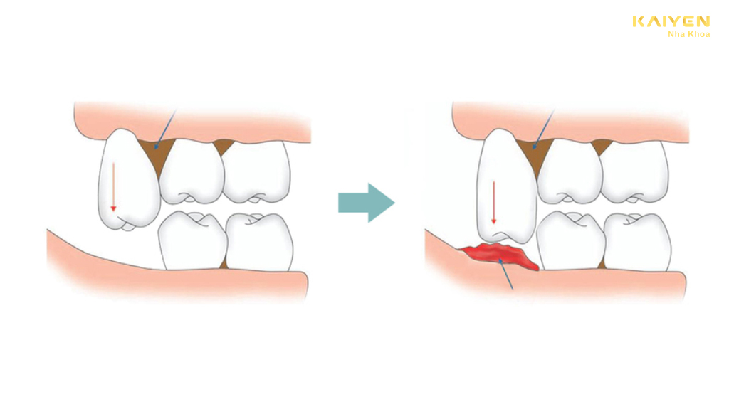 Nhổ răng khôn hàm trên có nguy hiểm không?