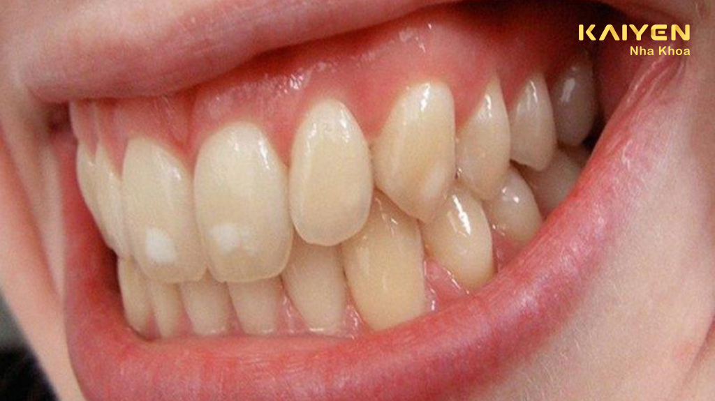 Dấu hiệu răng nhiễm tetracycline