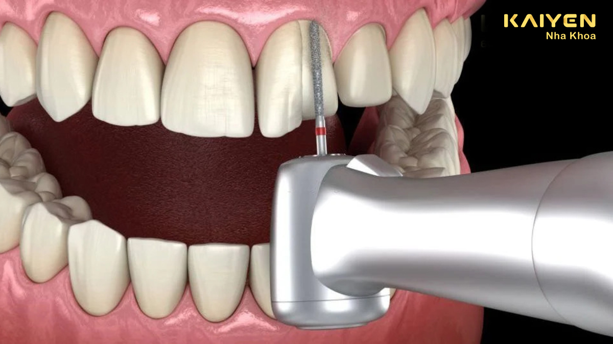 Mài răng bọc sứ có đau không?