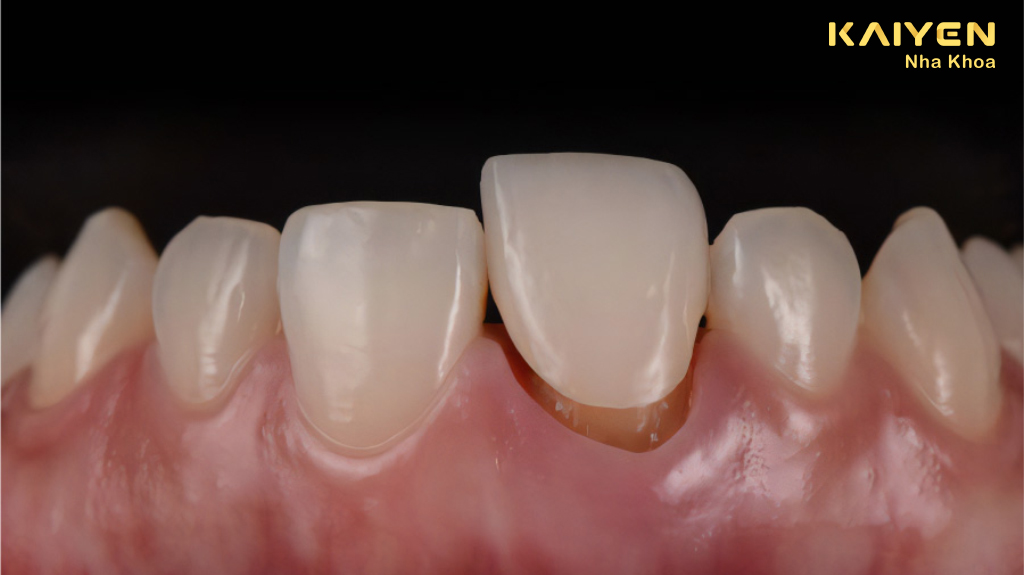 Răng sứ bị lung lay gây ảnh hưởng gì?
