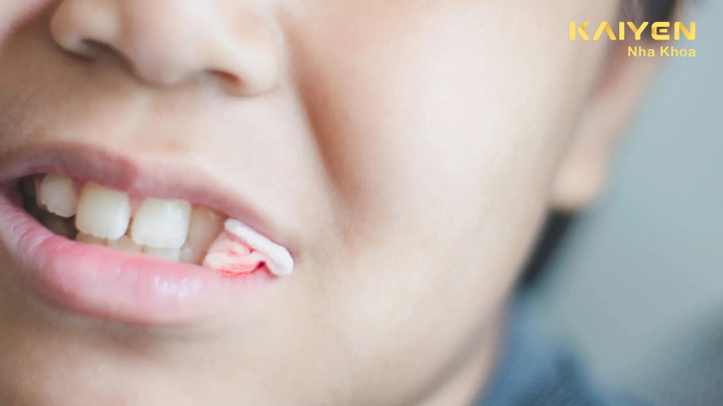 Lưu ý sau khi nhổ răng khôn là kiểm soát chảy máu
