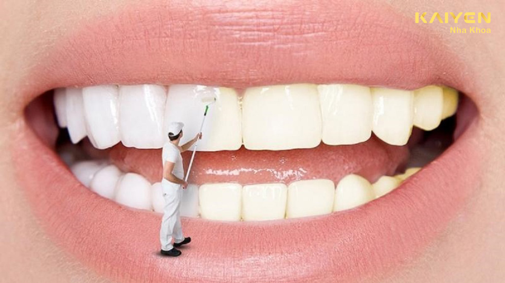 Tráng men răng là gì?