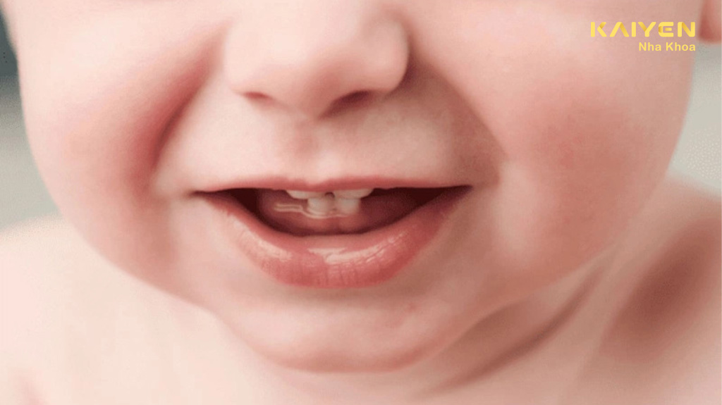 Răng sữa mọc lệch có ảnh hưởng đến răng vĩnh viễn không?