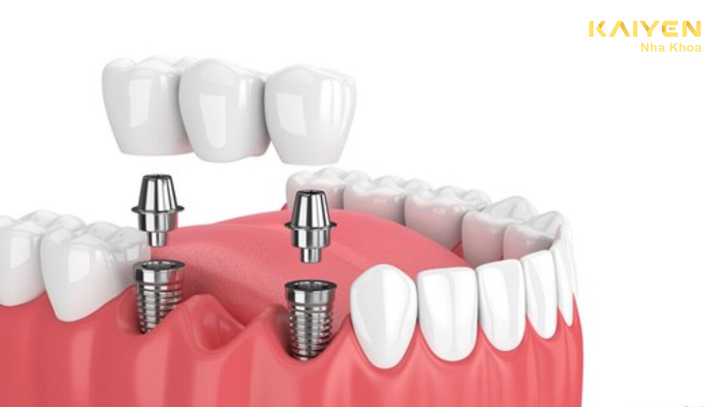 Cầu răng implant
