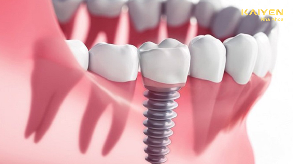 Bị viêm nha chu có trồng răng implant được không