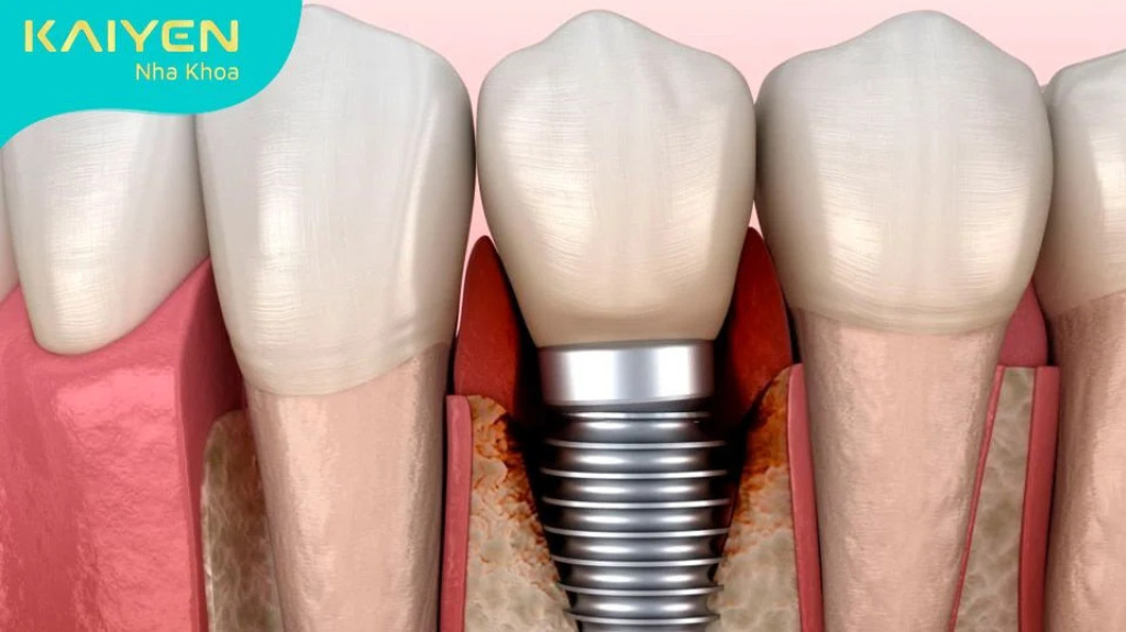 Trồng răng implant có gây dị ứng không?