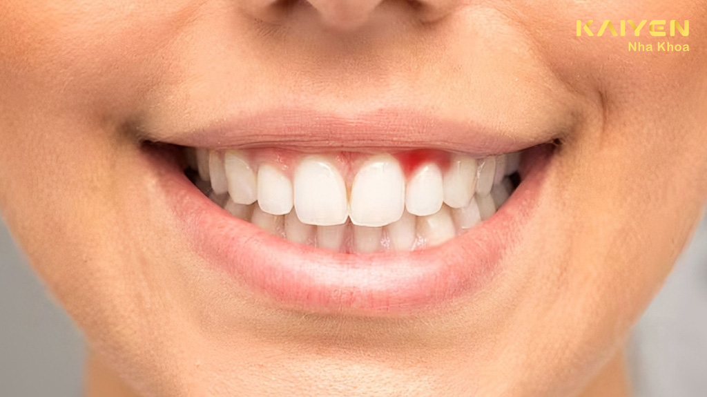 Bọc răng sứ bị viêm lợi