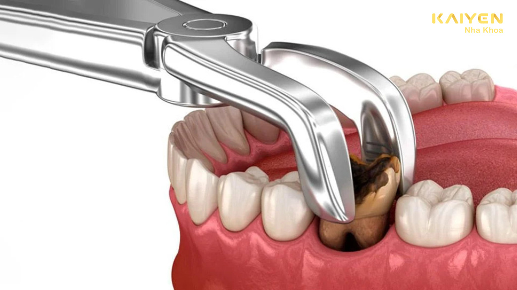 Trường hợp nhổ răng hàm bị sâu