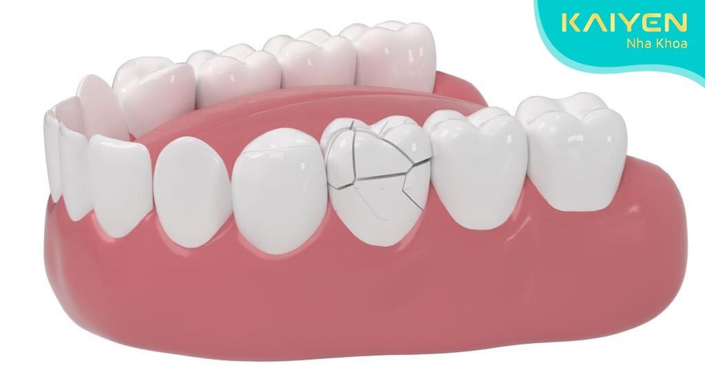 Biến chứng bọc răng sứ