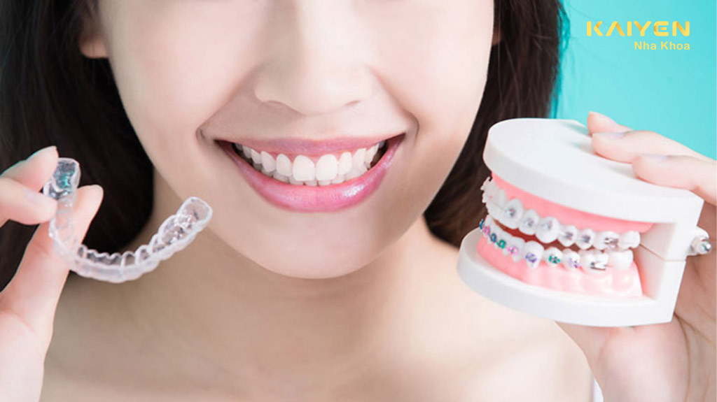 Niềng răng có vĩnh viễn không