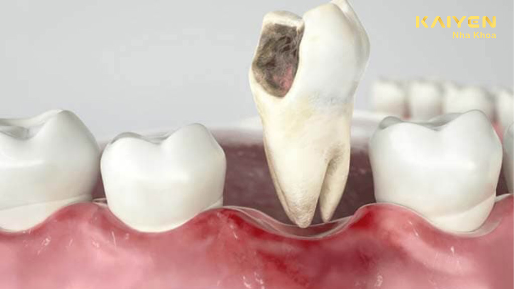Răng cấm bị sâu có nên nhổ không
