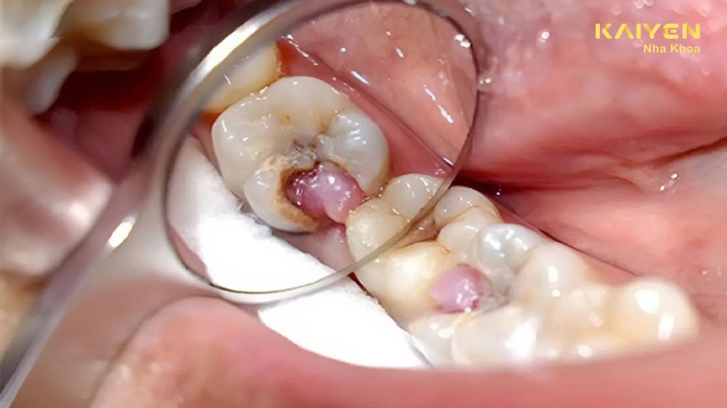 Răng sâu lồi thịt