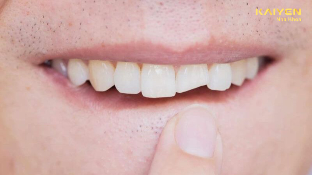 Trám răng mẻ có được không?