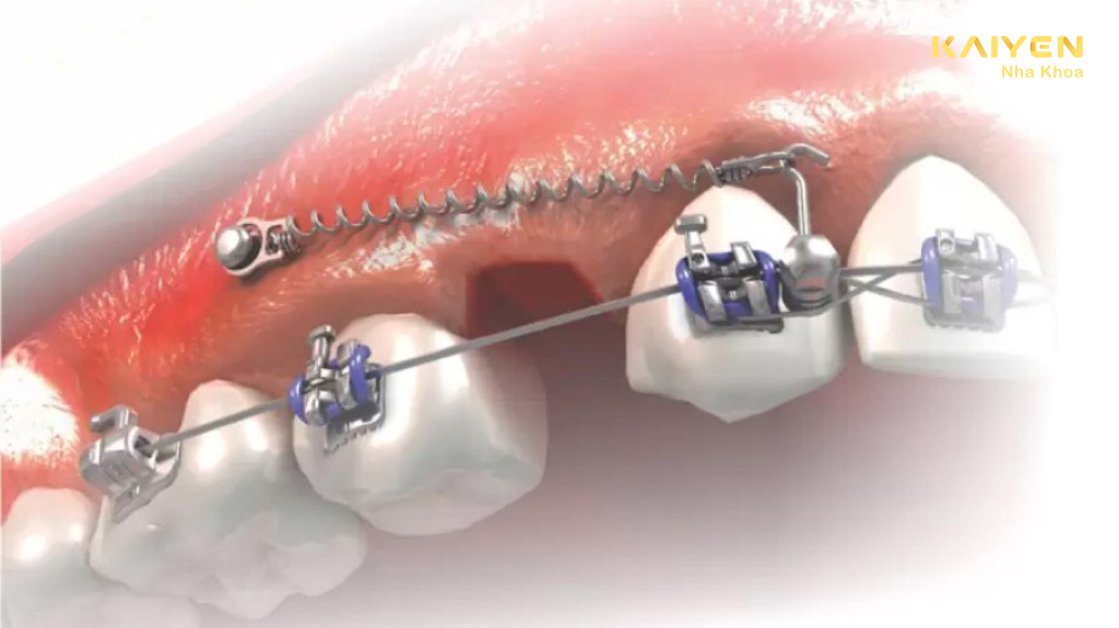 Bắt vít niềng răng bao lâu