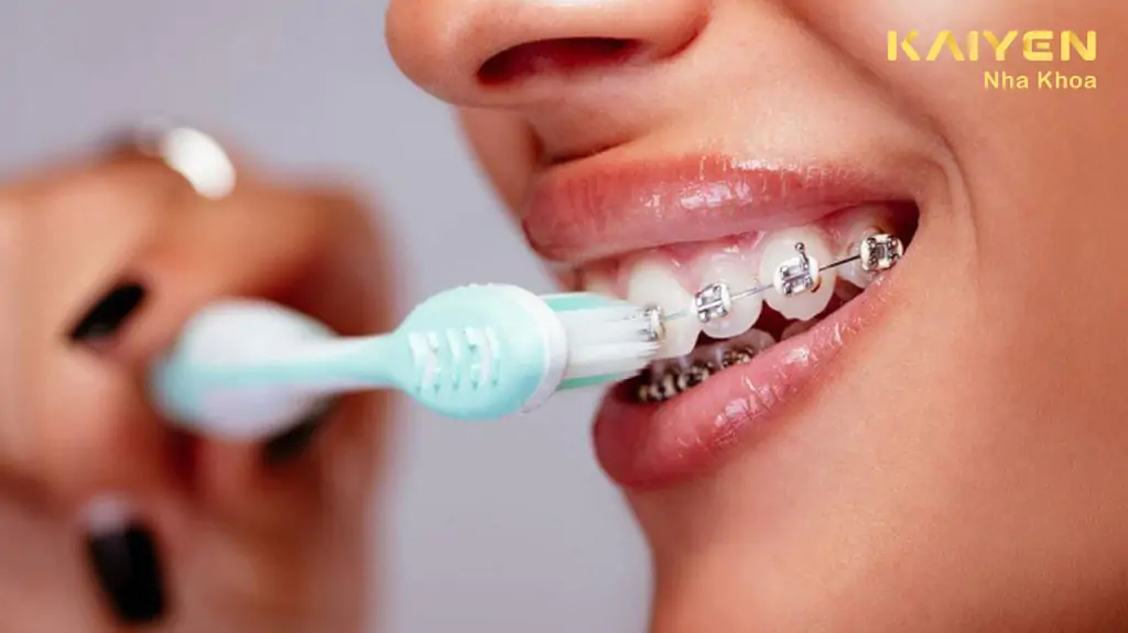 Chải răng thật kỹ và chải cả mắc cài