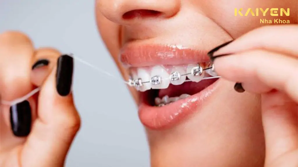 Vệ sinh bằng chỉ nha khoa