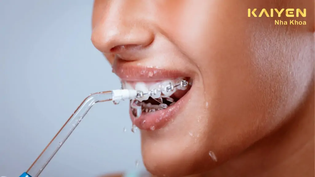 Vệ sinh răng miệng sau niềng răng bằng tăm nước