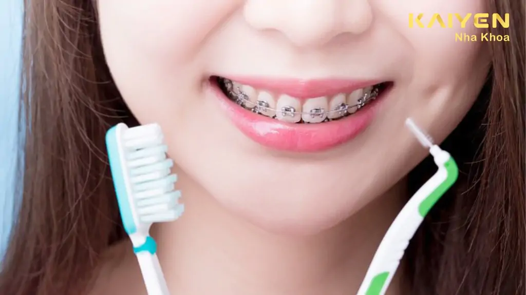 Vì sao phải vệ sinh răng miệng khi niềng răng