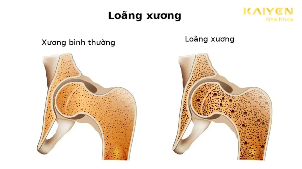 Loãng xương