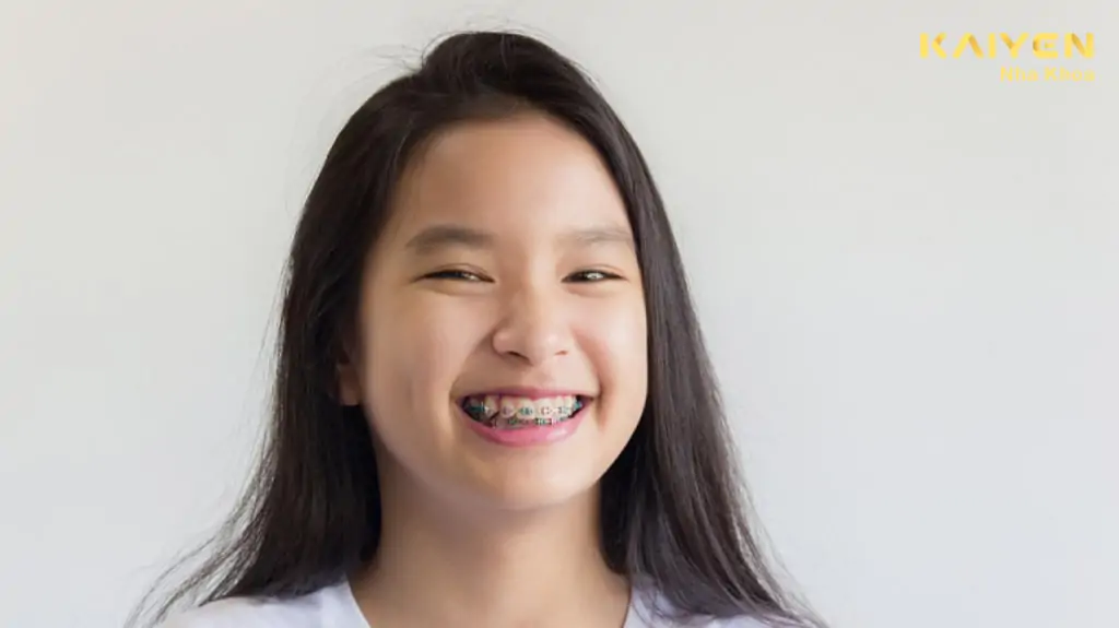 Niềng răng phòng ngừa các vấn đề về răng miệng cho trẻ em