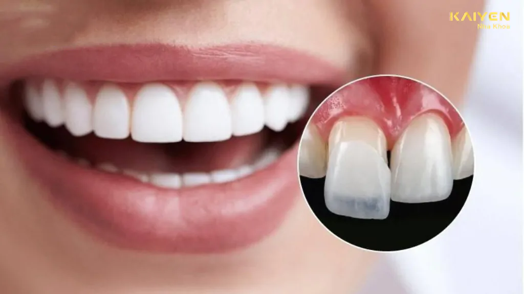 Tổng quan về bọc sứ răng cửa