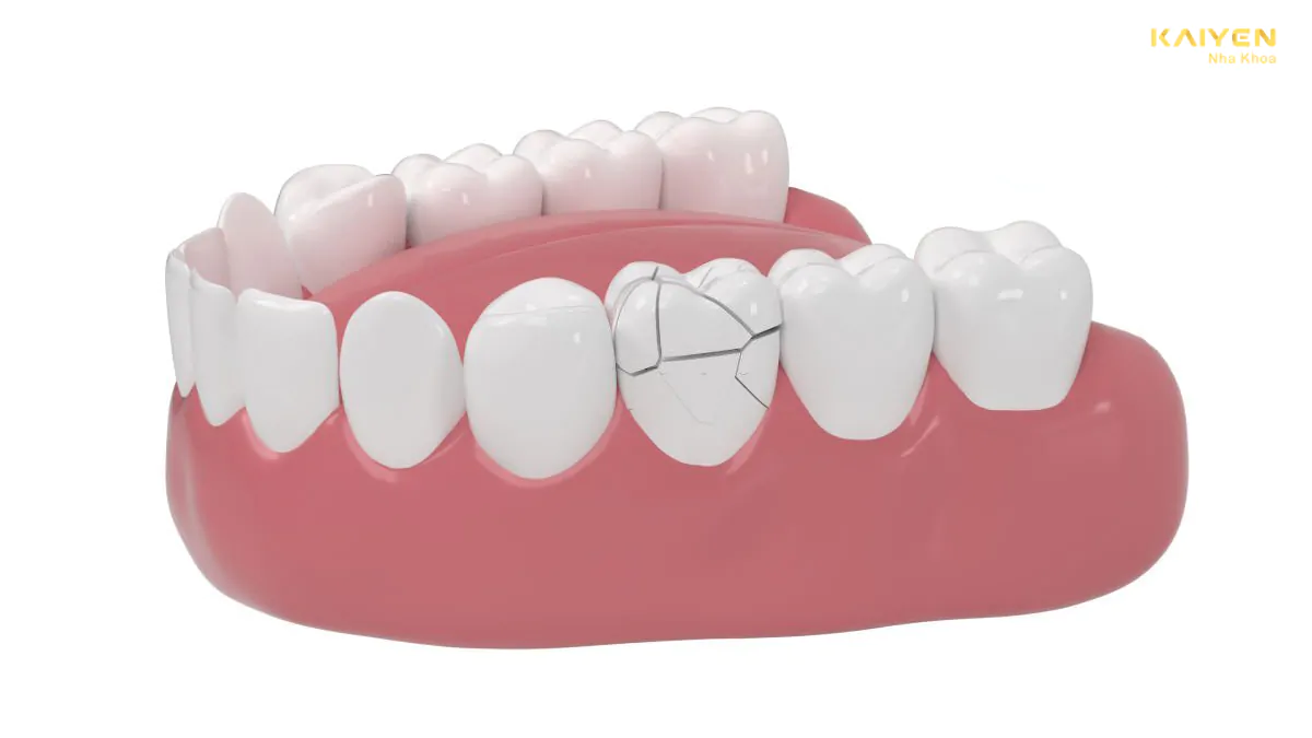 Răng sứ bị mẻ có trám được không