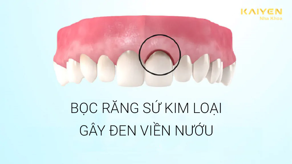 Tác hại của răng sứ kim loại gây đen viền nướu
