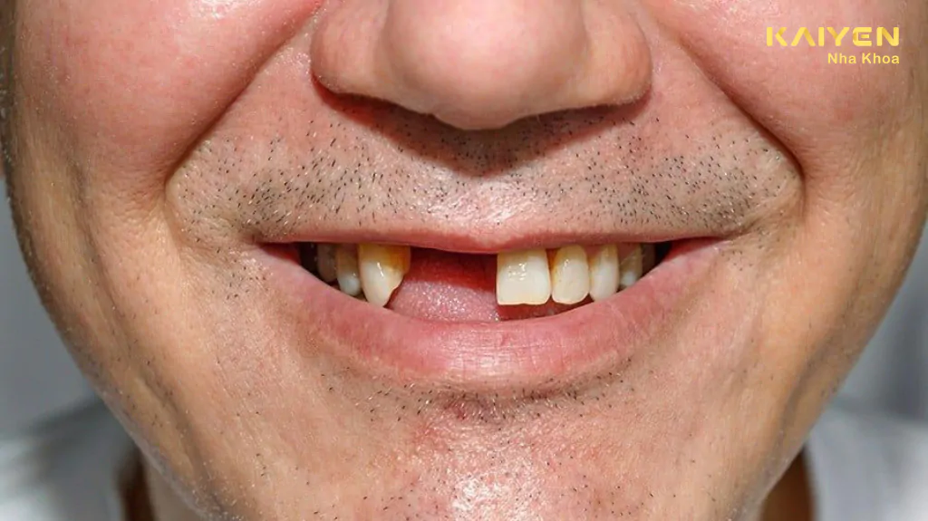 Mất 2 răng liền kề