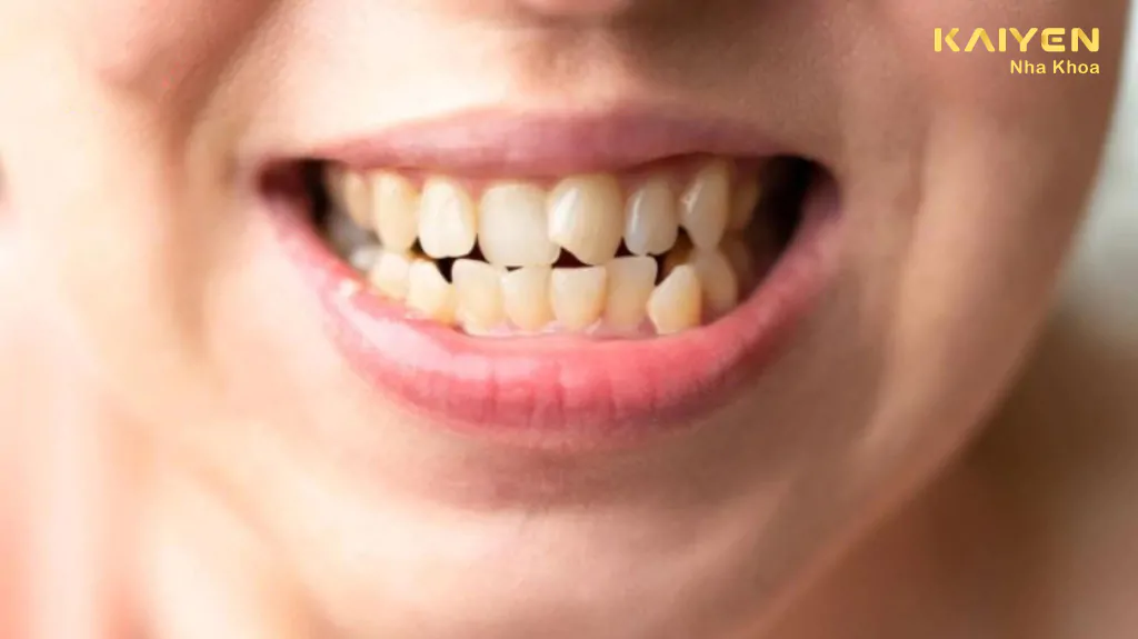 Răng lệch nhân trung