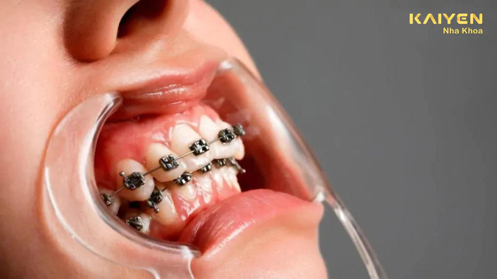 Niềng răng xong bị hô