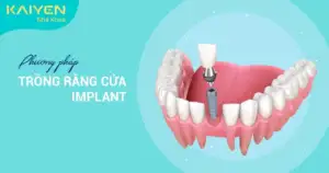 trồng răng cửa implant