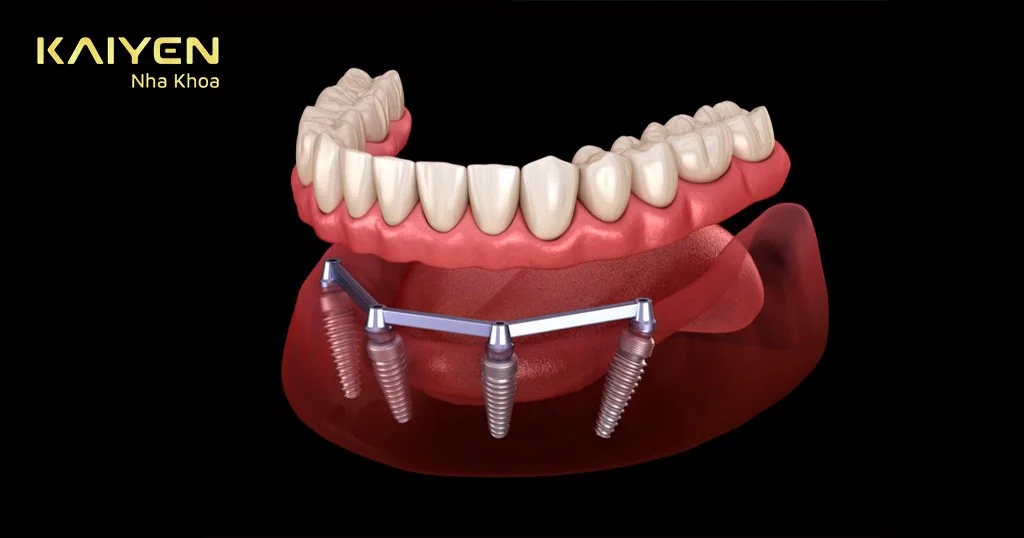 hàm tháo lắp trên implant