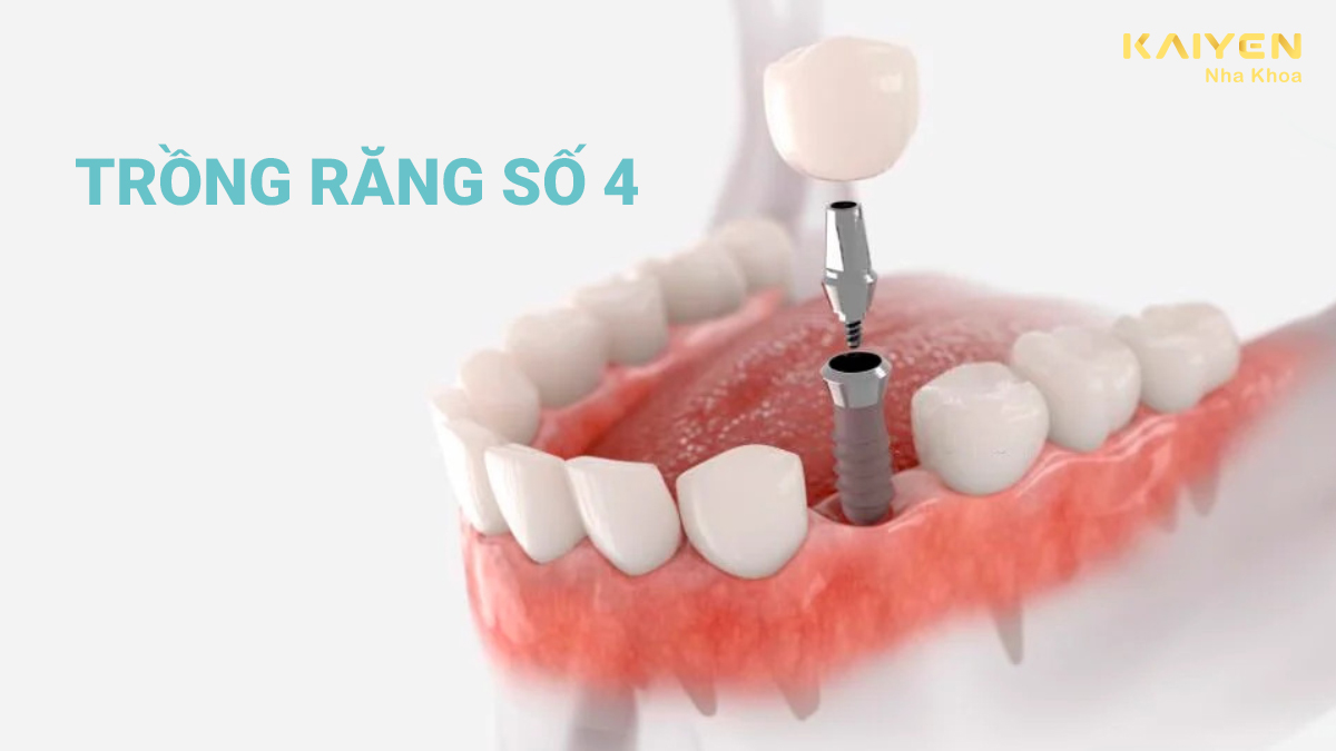 Trồng răng số 4