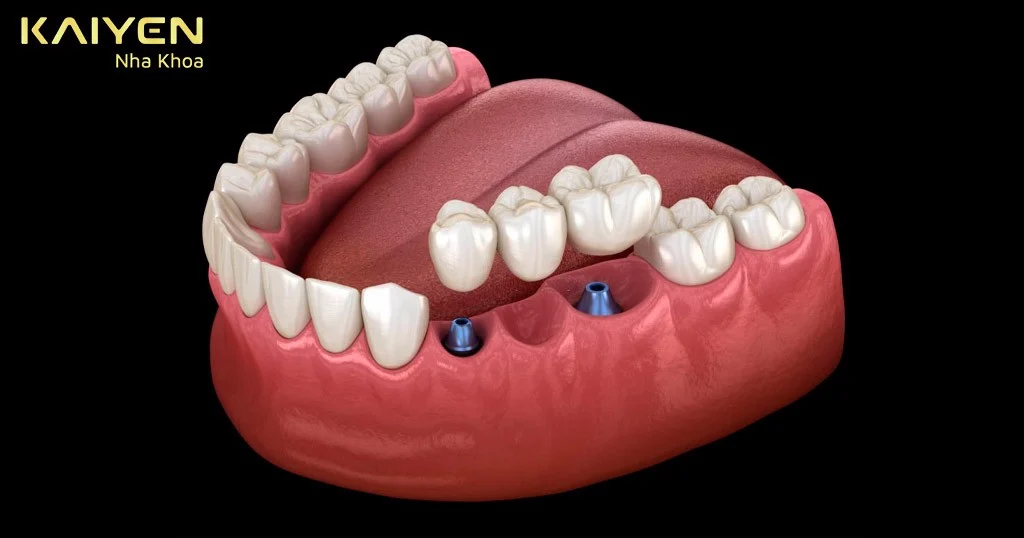 nhược điểm của trồng răng implant