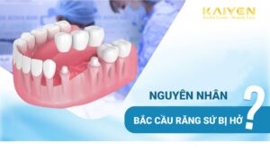 Bắc cầu răng sứ bị hở