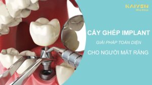 Cấy ghép implant