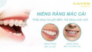 Niềng răng mắc cài