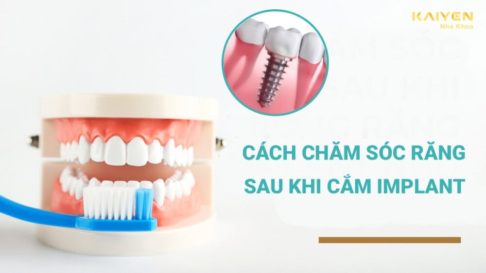 Cách chăm sóc răng sau khi cắm Implant