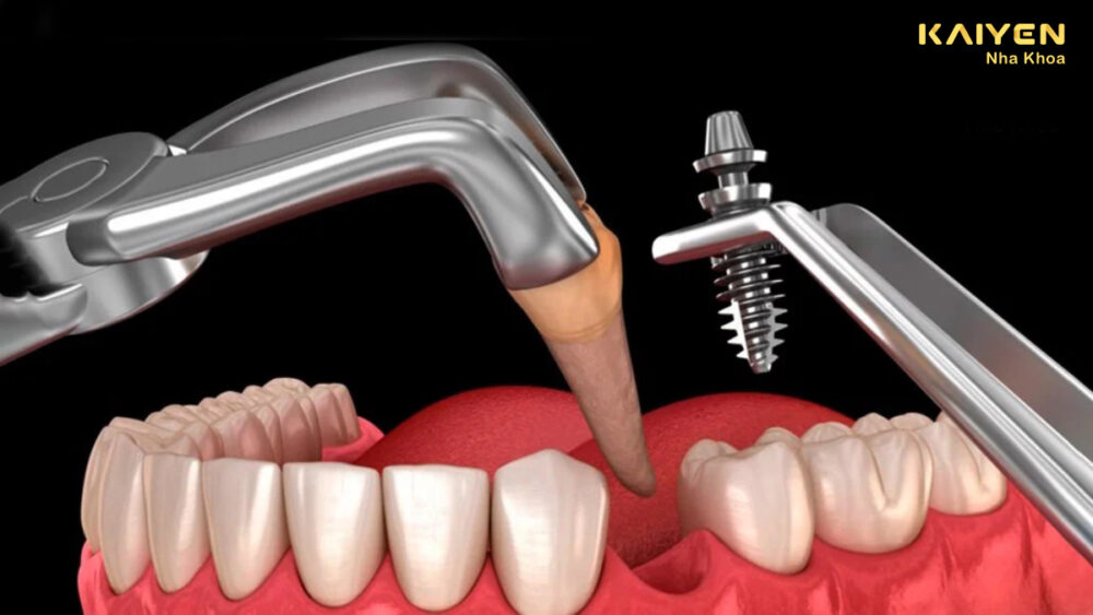 Nhổ răng bao lâu thì cấy implant được