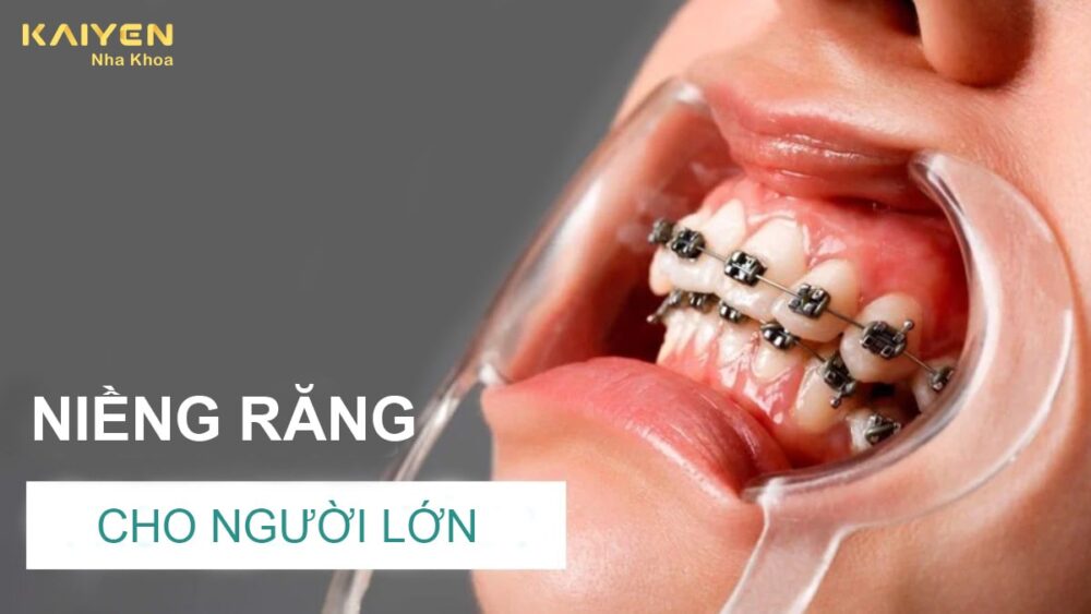 Niềng răng cho người lớn