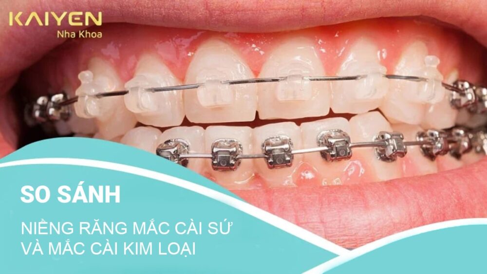 Niềng răng mắc cài sứ và kim loại