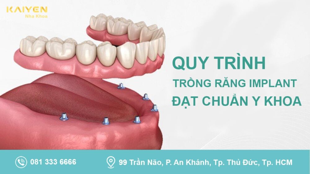 Quy trình trồng răng Implant