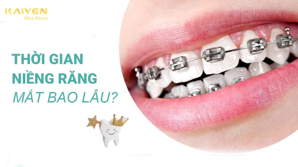Thời gian niềng răng mất bao lâu