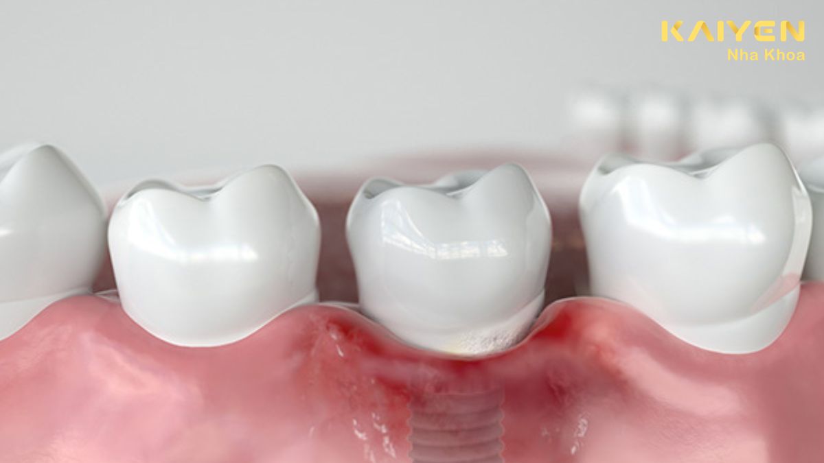 Biến chứng khi trồng răng Implant