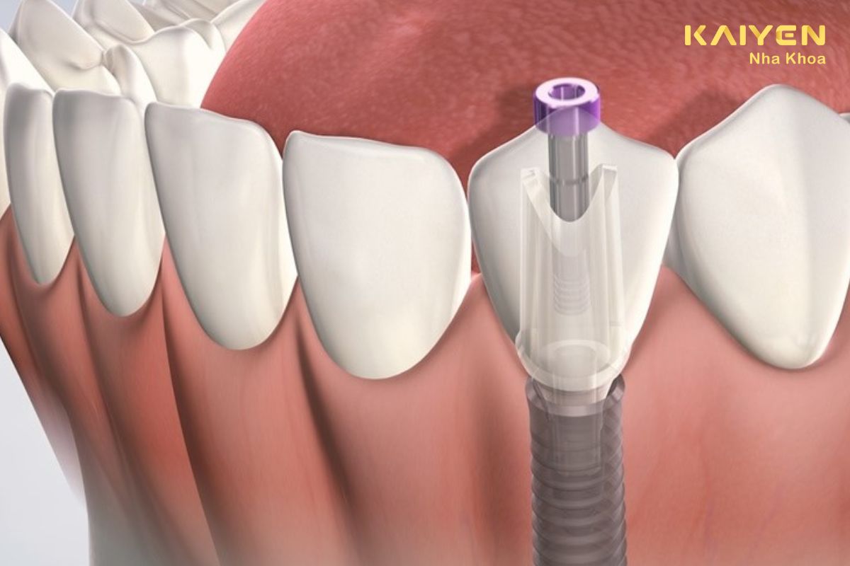 Có nên trồng răng Implant