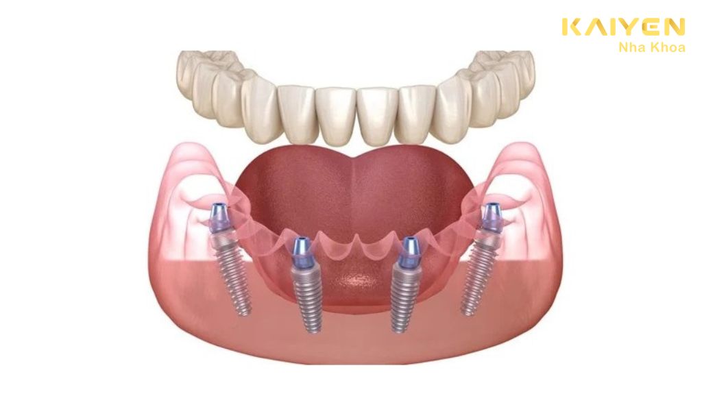 Trồng răng Implant toàn hàm kỹ thuật All on 4