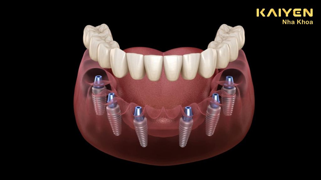 Trồng răng Implant toàn hàm kỹ thuật All on 6