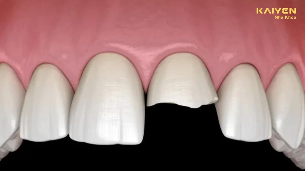 răng sứ trên implant bị vỡ 